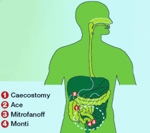 ostomy